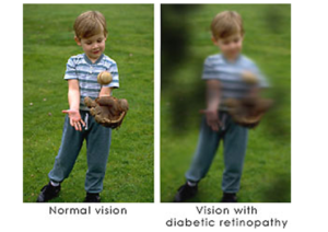 Diabetic Retinopathy vision example | New Berlin, WI Eye Doctor | Lang Family Eye Care