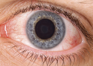 Dry Eye Syndrome Chronic Dry Eye | New Berlin, WI Eye Doctor | Lang Family Eye Care