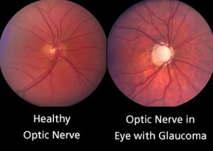 Glaucoma Treatment Specialists | Lang Family Eye Care | New Berlin, WI