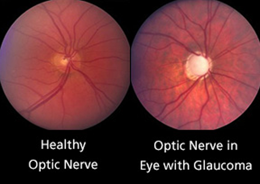 glaucoma eye vs normal eye